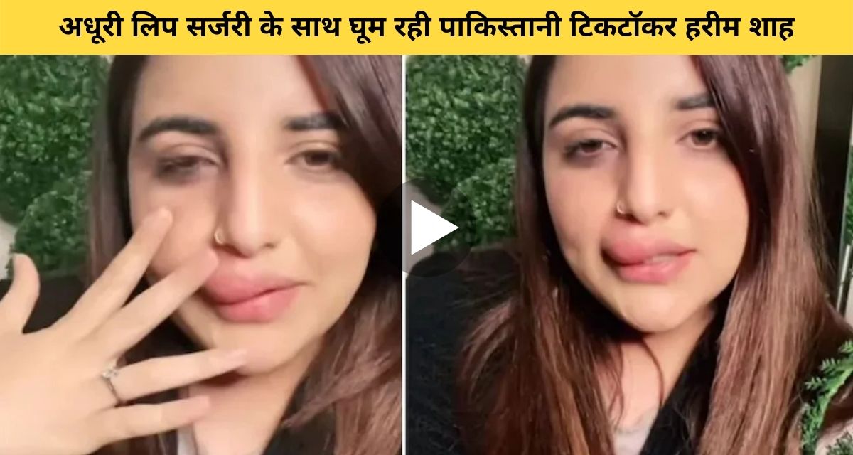 Pakistani Tiktokker Harim Shah's incomplete lip surgery